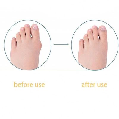 TPR Adulto Limpiador de Pies Grandes Corrección de Bunion Día/Noche Niños Limpiador de Dedos del Pulgar Para Zapatos
